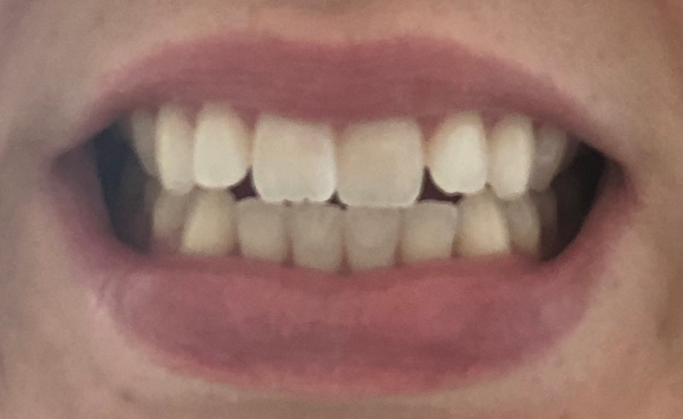 I did Invisalign as an adult!